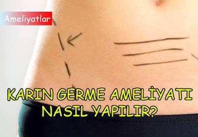 Ameliyatsız Karın Germe Ameliyatsız Karın Germe