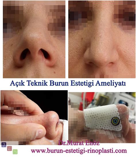 Burun Ameliyatı Sonrası Masaj