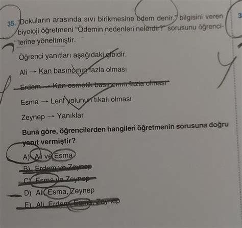 Burun Ameliyatı Sonrası Ödem Burun Ameliyatı Sonrası Ödem