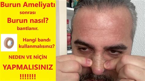 Burun Ameliyatı Sonrası Ödem Burun Ameliyatı Sonrası Ödem