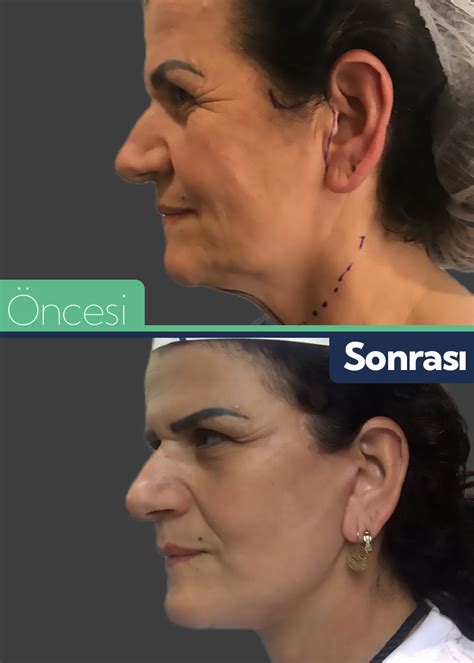 Kaş Kaldırma ve Yüz Estetiği