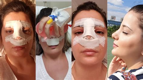 Burun Ameliyatı Geçiren Sporcular Burun Ameliyatı Geçiren Sporcular
