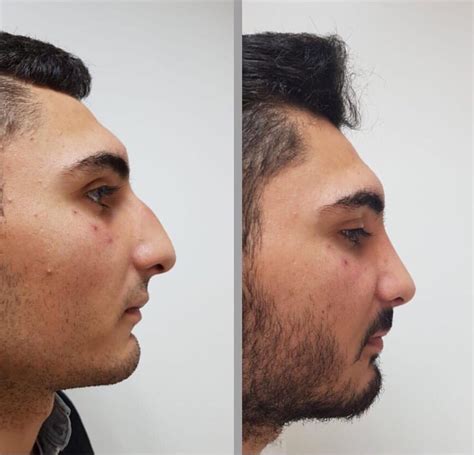 Burun Küçültme Ameliyatı